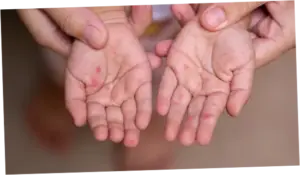 Dinkes Banten Ungkap Masih Ada Ortu yang Tolak Anaknya Divaksin Campak