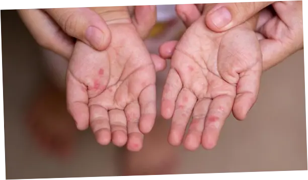 Dinkes Banten Ungkap Masih Ada Ortu yang Tolak Anaknya Divaksin Campak